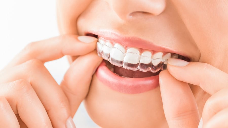 Smile Design 1 closeup female teeth clear aligners