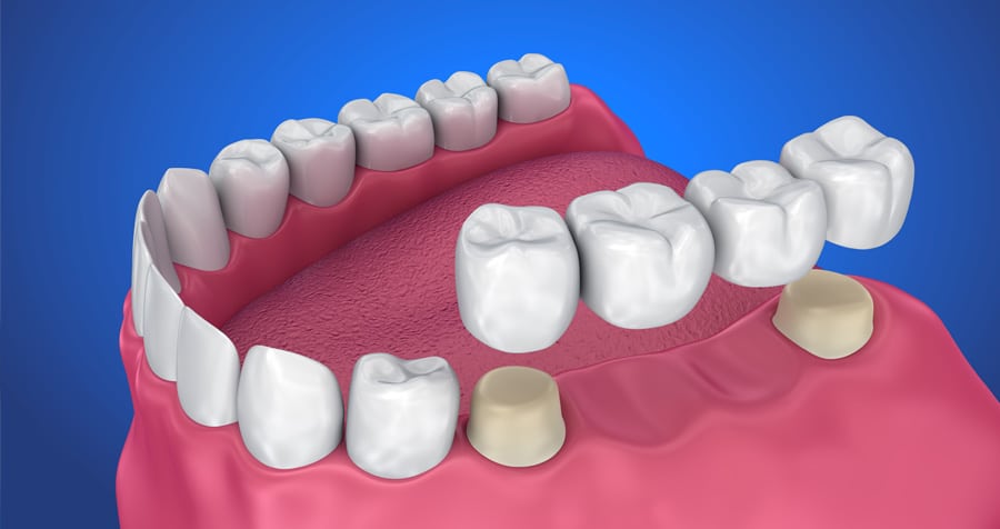 Dental Crowns 1 3D rendering of a dental crown and bridge placed on top of teeth