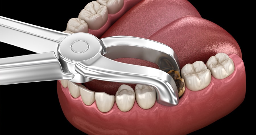 Extractions 1 3D rendering of a tooth extraction procedure, showing the removal of a tooth