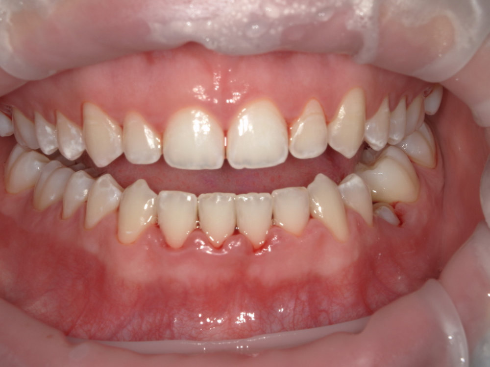 EMS Guided Biofilm Therapy (GBT) 3 EMS Case 1 After
