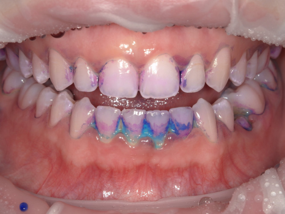 EMS Guided Biofilm Therapy (GBT) 2 EMS Case 1 Before
