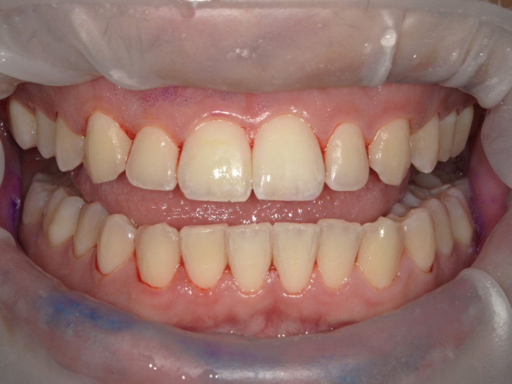 EMS Guided Biofilm Therapy (GBT) 5 EMS Case 2 After