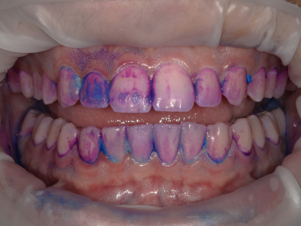 EMS Guided Biofilm Therapy (GBT) 4 EMS Case 2 Before