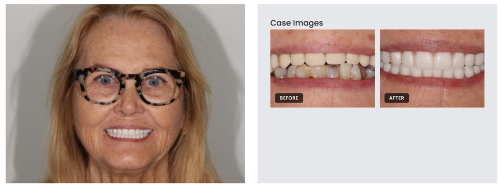 Dental Implants 2 patient case on or before