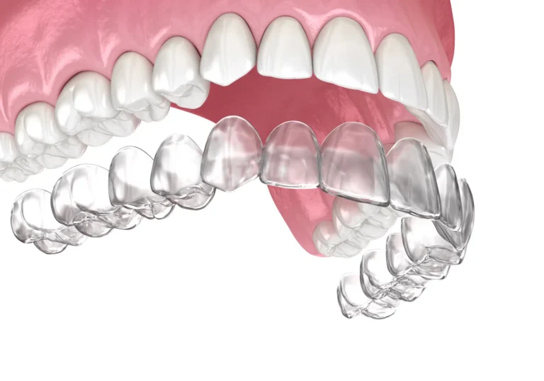 How Custom Clear Aligners Transform Complex Teeth Alignments Invisibly 4 AdobeStock 404574839
